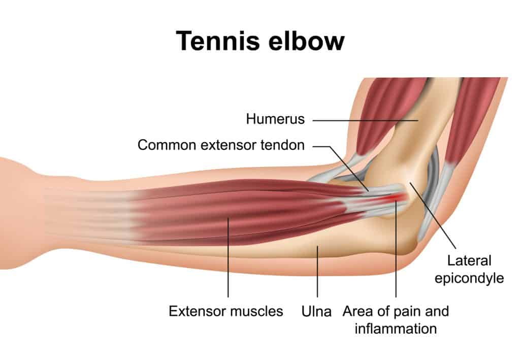 drawing of the elbow as an anatomy demonstration in an article about how long does tennis elbow last