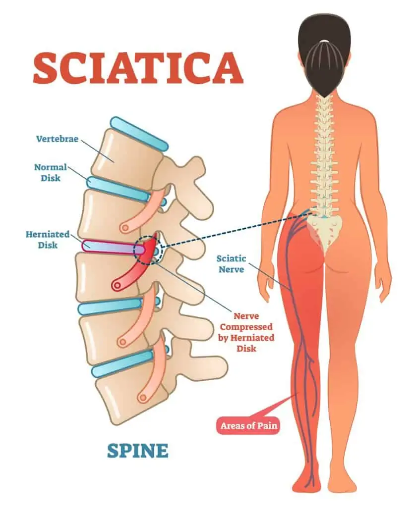 Top 4 Reasons for Sciatica Pain and What You Can Do About It - AVALA