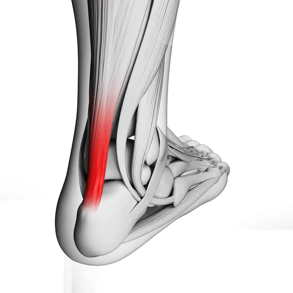 Heel Pain: Achilles Tendonitis vs. Plantar Fasciitis: Minneapolis Vein  Center: Interventional Radiologists