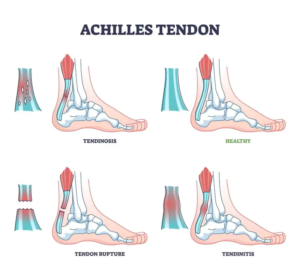 Achilles tendonitis, Brighton physio explains treatment at home - Sundial  Clinics
