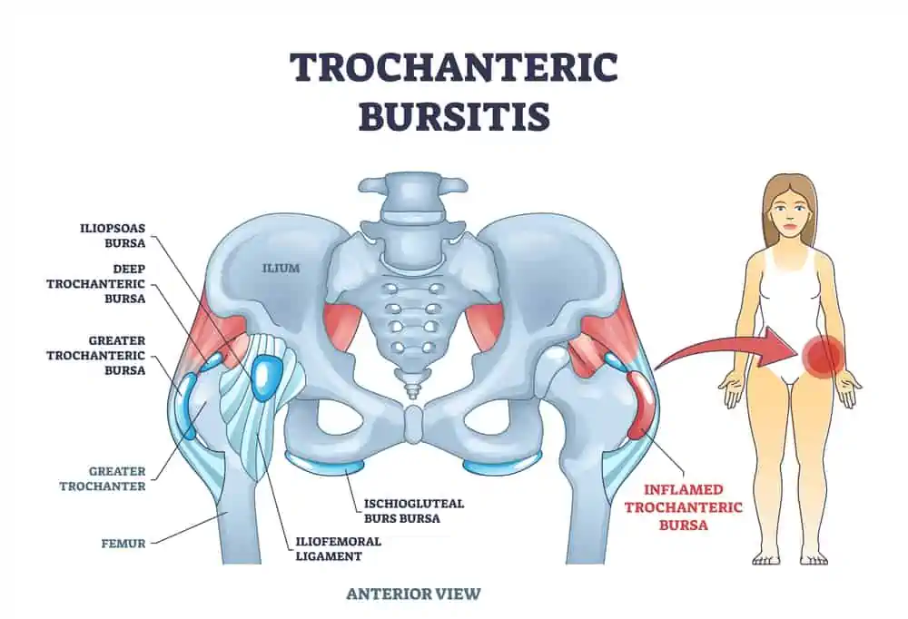 6 Things To Avoid With Hip Bursitis - EMPOWER YOURWELLNESS